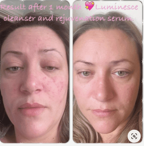 Before and after photos of person claiming to be using Jeunesse anti-aging products in the article Jeunesse Global Products. Genuine MLM or 1 Big Pyramid Scheme
